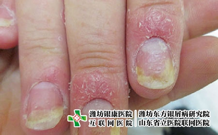 指甲牛皮癬1