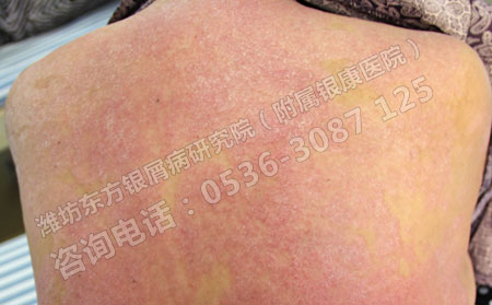 常見的銀屑病有哪些
