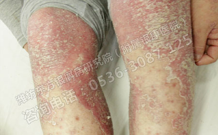 濰坊哪家醫院可以治療膿皰型銀屑病