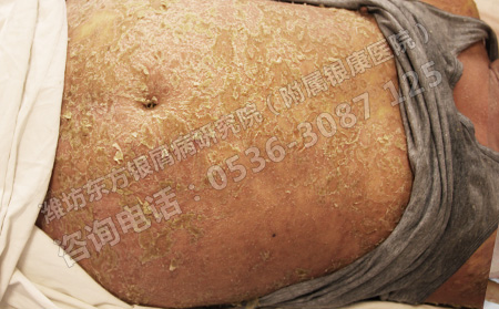 濰坊銀康醫(yī)院治牛皮癬優(yōu)勢(shì)