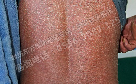 銀屑病患者身體出現瘙癢怎么辦