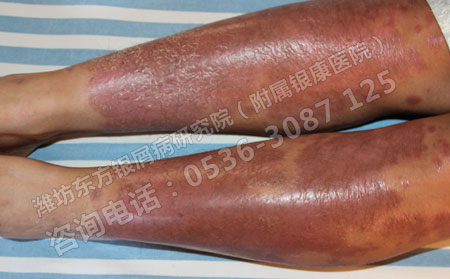 合適紅皮病型銀屑病治療的方法是什么