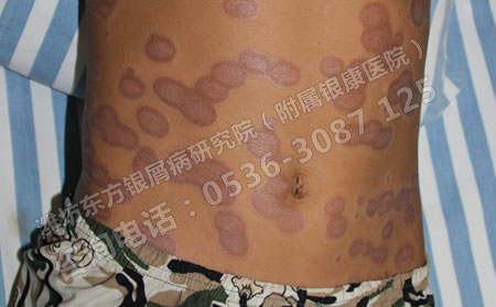 治療兒童銀屑病的重點(diǎn)在哪里