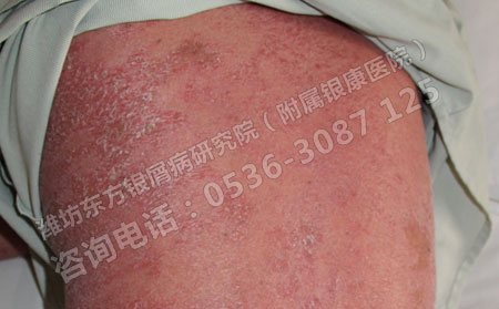 常運動對老年牛皮癬患者有什么可以處呢？
