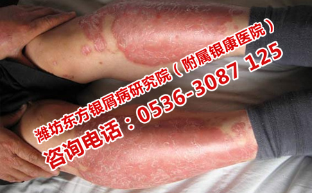 治療牛皮癬靠譜的方法是什么