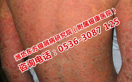 濰坊哪個(gè)醫(yī)院治療銀屑病可以