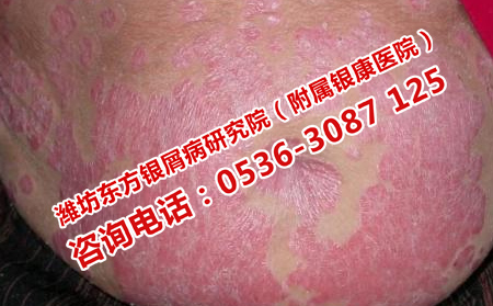銀屑病的治療要注意哪些問題