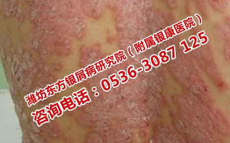 護(hù)理老年牛皮癬的方法是什么