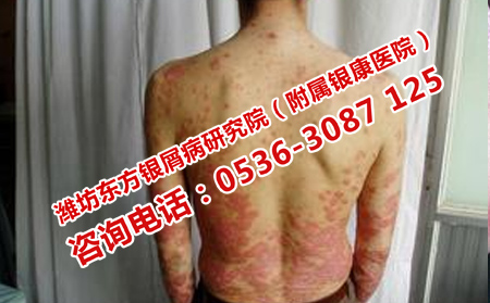 銀屑病患者如何養(yǎng)生