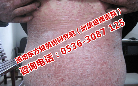 晚期銀屑病怎么治療