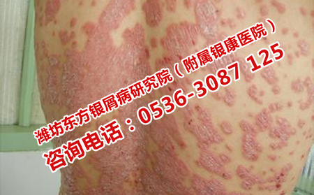 牛皮癬復發怎么辦