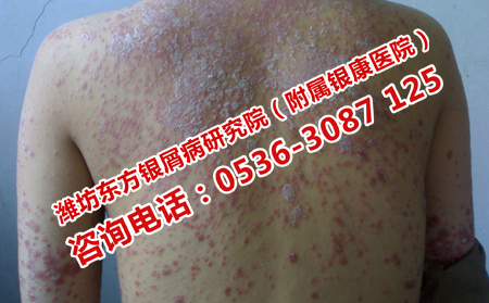 牛皮癬不及時治療的危害