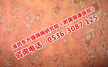 哪種方法治療牛皮癬有效 