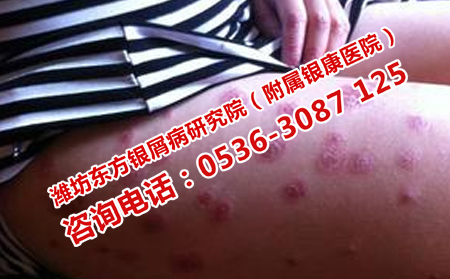 牛皮癬恢復(fù)的幾率是大多呢