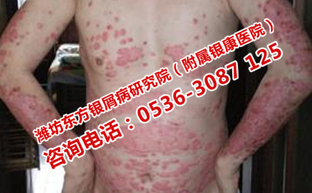 尋常型牛皮癬為什么惡化