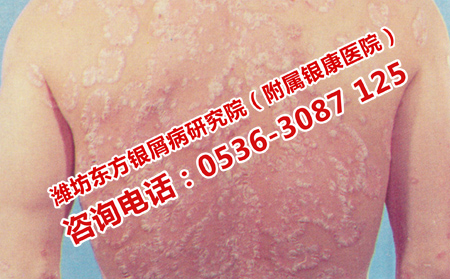 臉部牛皮癬如何快速消退