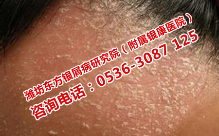 如何預防牛皮癬