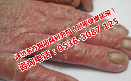 濰坊牛皮癬醫院治療費用