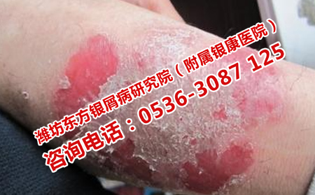 哪里醫院治銀屑病可以