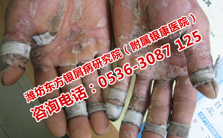 銀屑病復發去哪里看