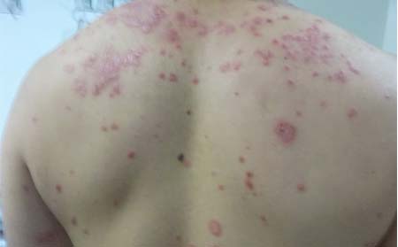 點滴型銀屑病,濰坊東方銀屑病研究院,濰坊銀屑病到哪家治療好