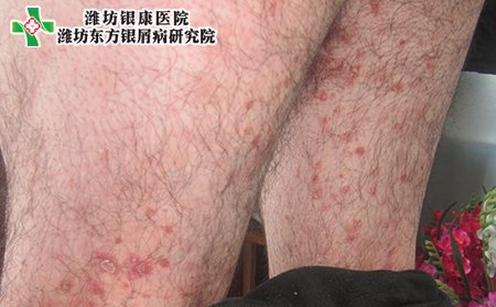 濰坊銀康醫院：治療銀屑癬的快速的藥物