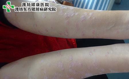 銀屑病關節炎是什么?發病原因是什么?